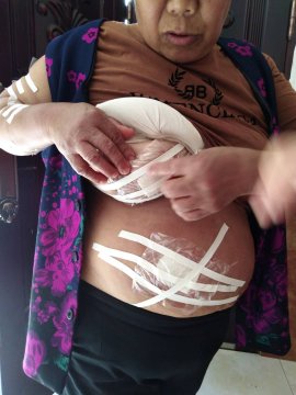 乳腺肿瘤