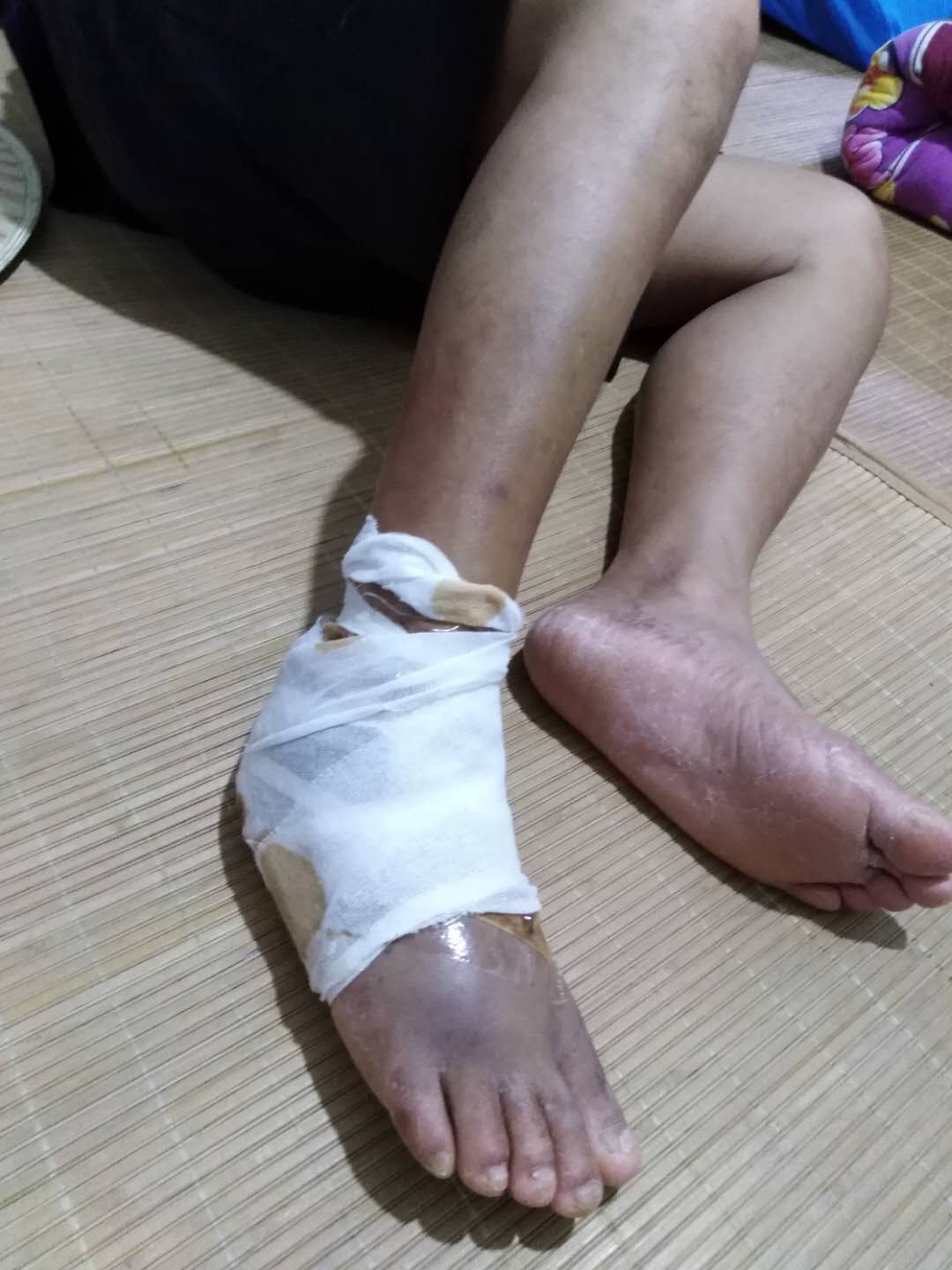 脚骨折患者
