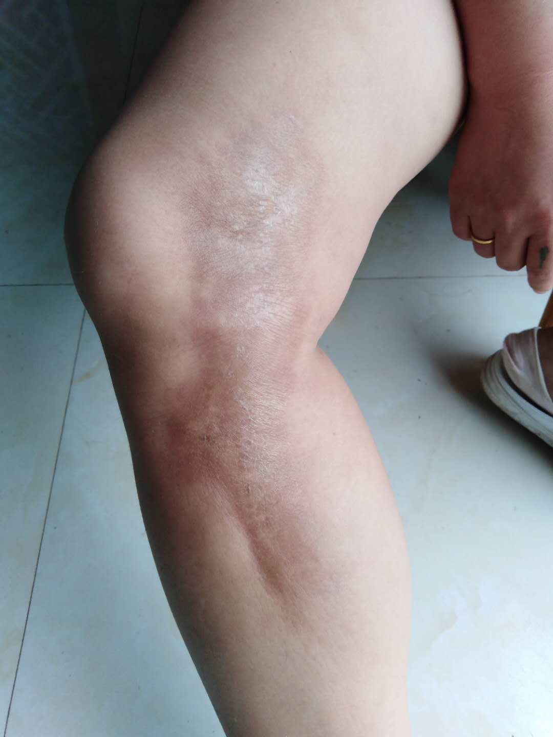 多年骨质皮肤坏死发黑将痊愈的图片